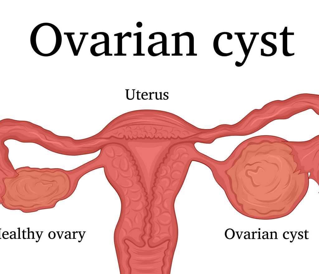 ovarian cyst combination 
