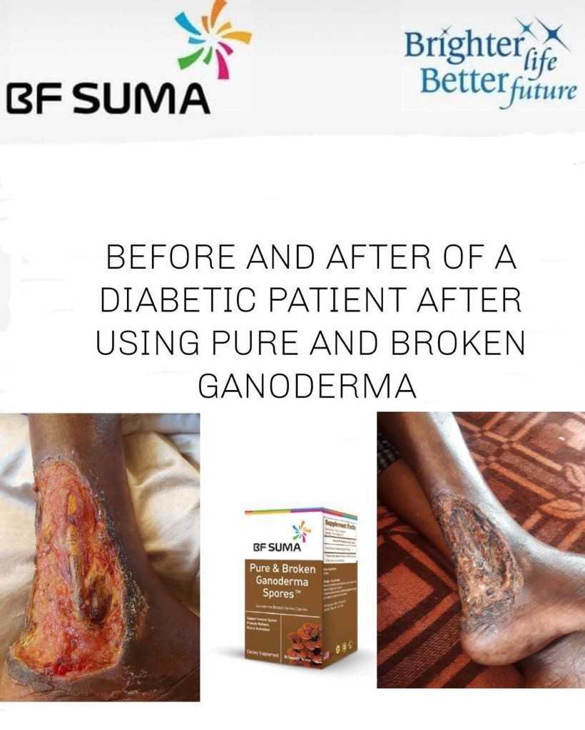 Diabetes cure